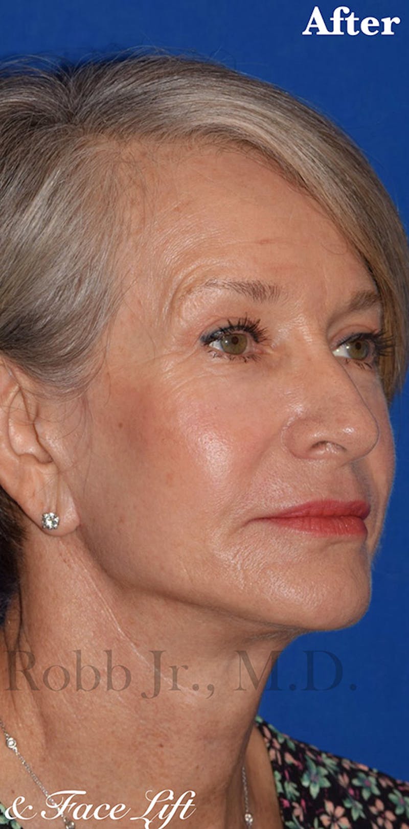 Face Before & After Gallery - Patient 63360773 - Image 4