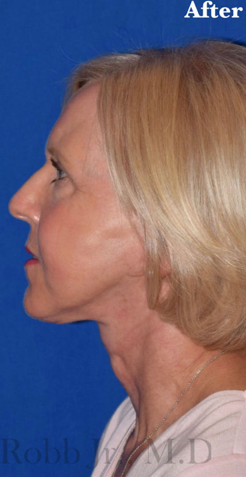 Non-Surgical Before & After Gallery - Patient 63360772 - Image 6