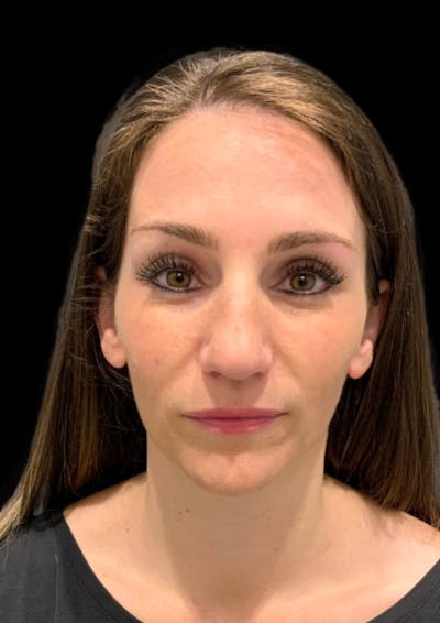Cosmetic Surgical Before & After Gallery - Patient 63360776 - Image 1