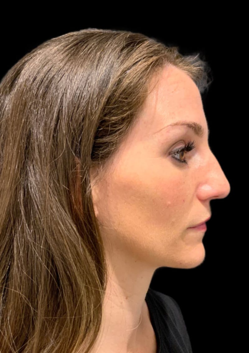 before and after rhinoplasty