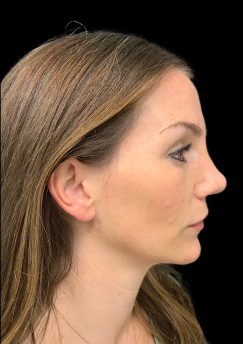 before and after rhinoplasty