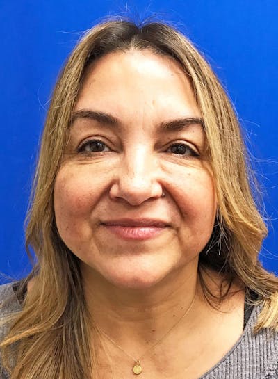 Face Before & After Gallery - Patient 63360780 - Image 2