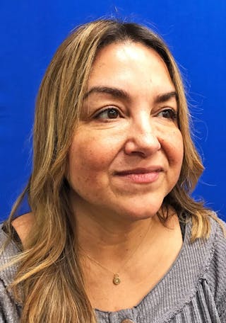 Face Before & After Gallery - Patient 63360780 - Image 4