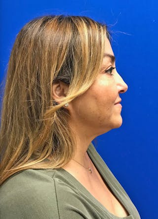 Face Before & After Gallery - Patient 63360780 - Image 6