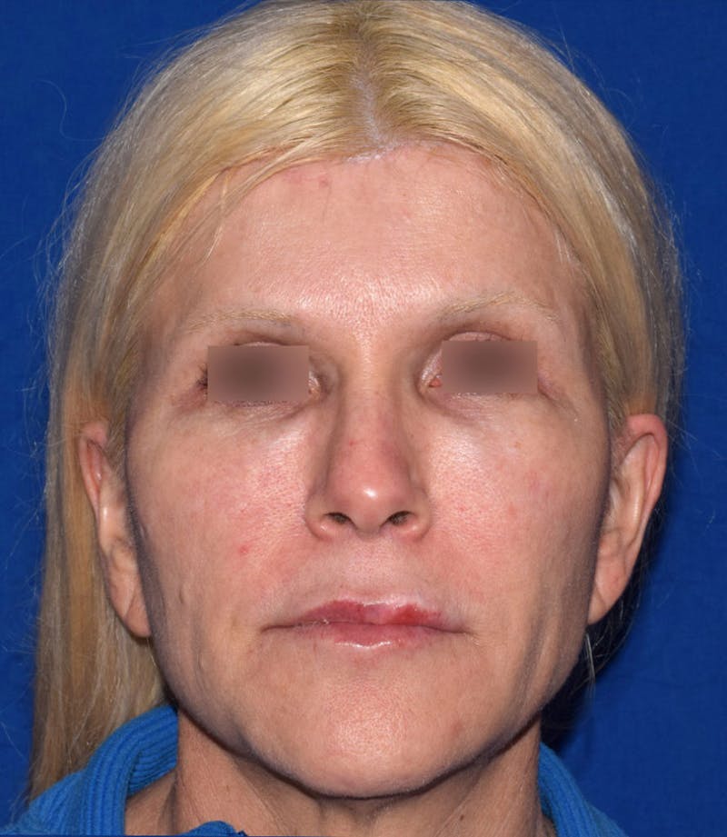 Face Before & After Gallery - Patient 63360782 - Image 1