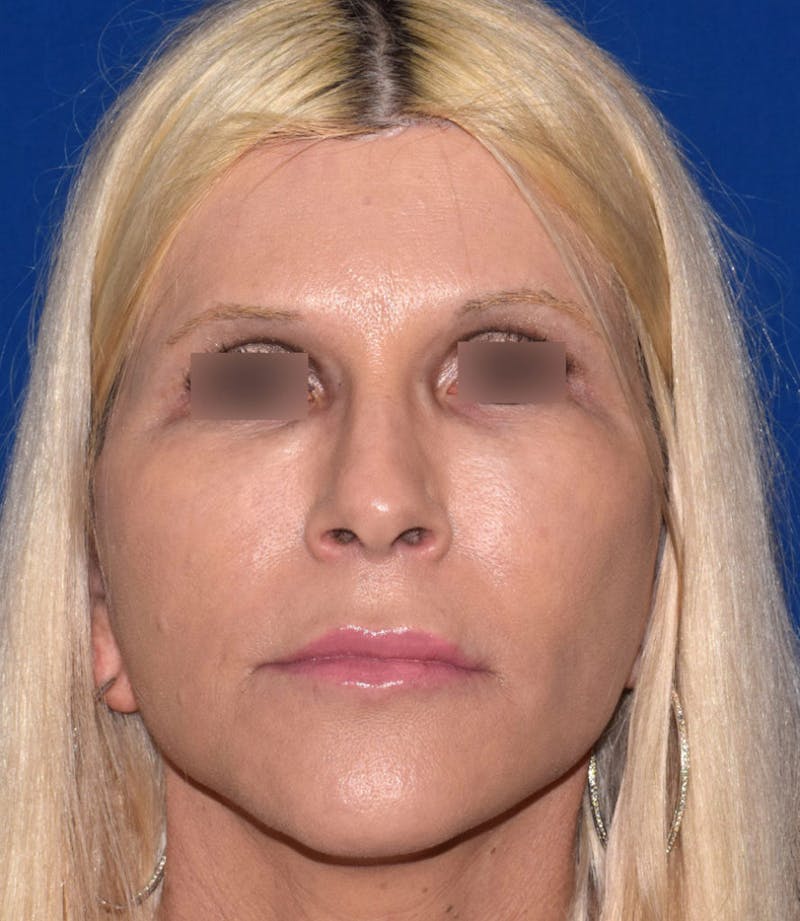 Face Before & After Gallery - Patient 63360782 - Image 2
