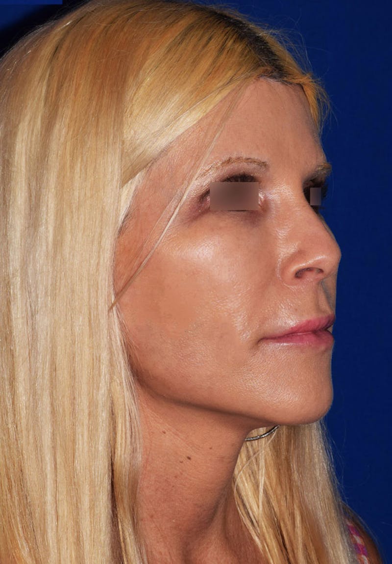Face Before & After Gallery - Patient 63360782 - Image 4