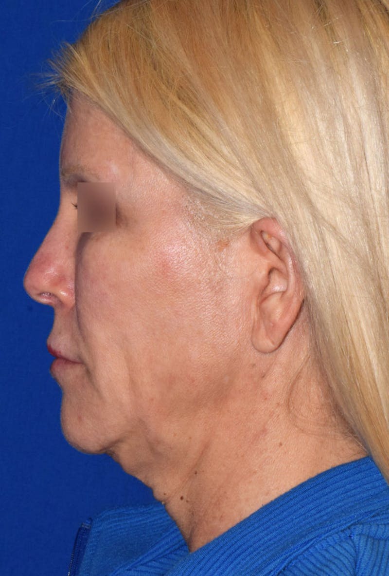 Cosmetic Surgical Before & After Gallery - Patient 63360782 - Image 5