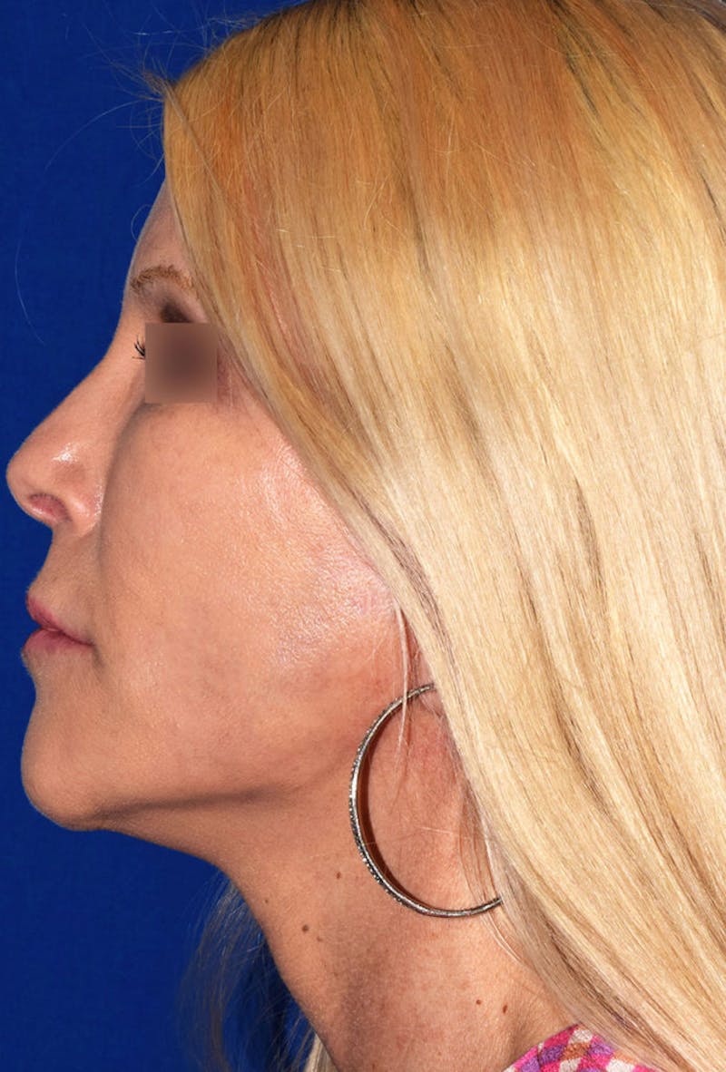 Cosmetic Surgical Before & After Gallery - Patient 63360782 - Image 6