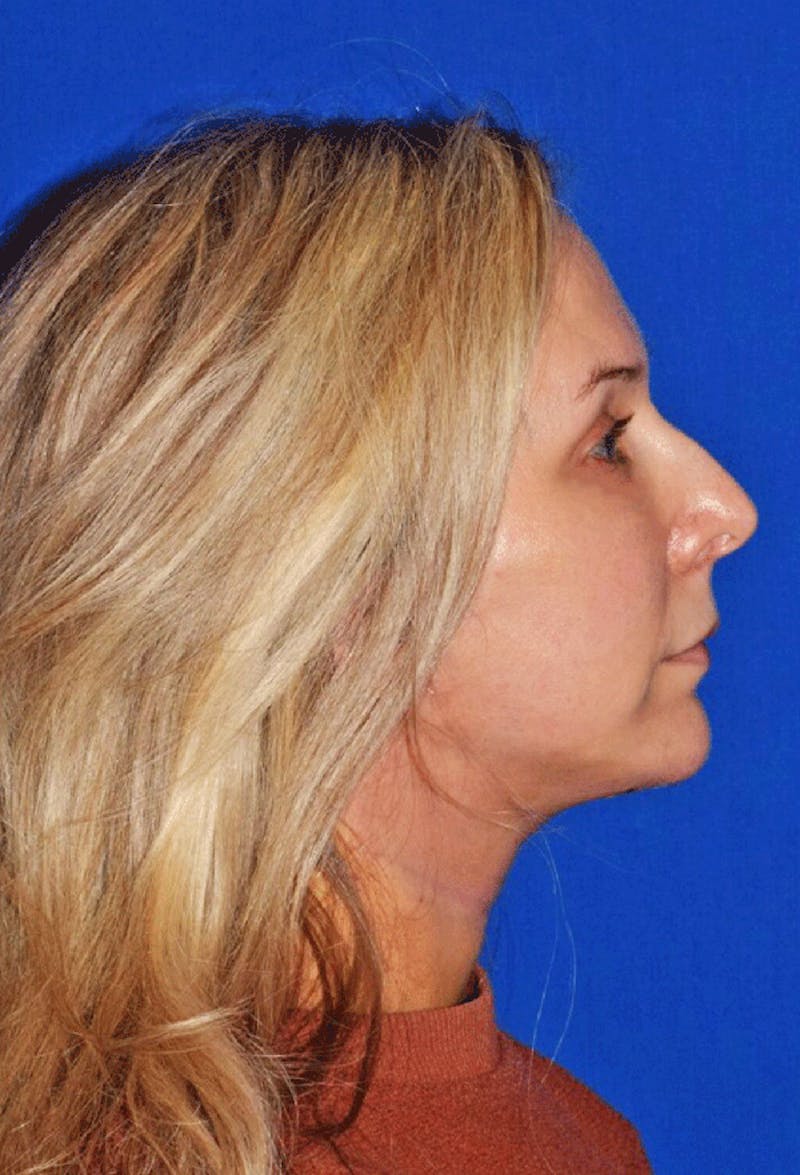 Cosmetic Surgical Before & After Gallery - Patient 63360783 - Image 6