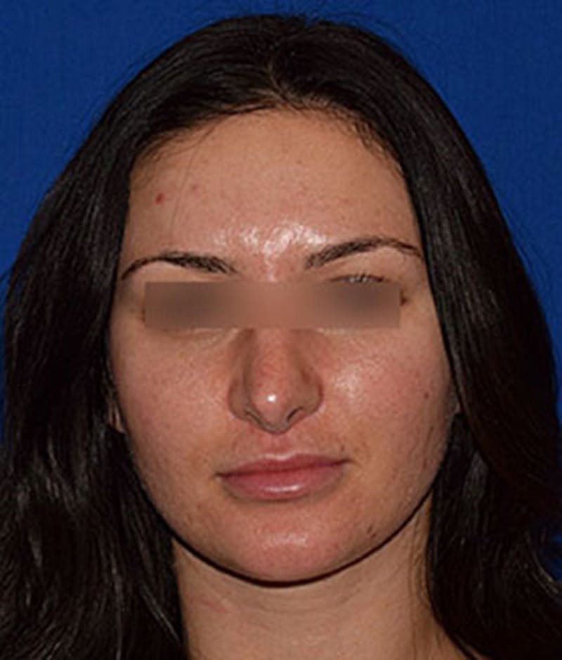 Face Before & After Gallery - Patient 63360789 - Image 1