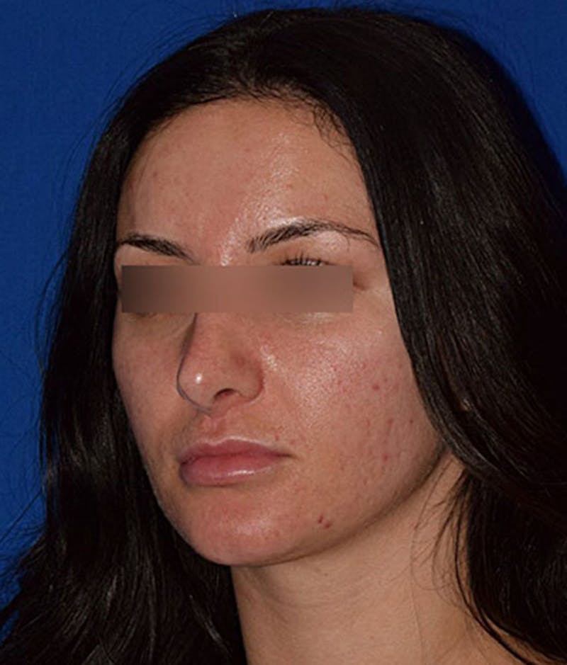 Face Before & After Gallery - Patient 63360789 - Image 3