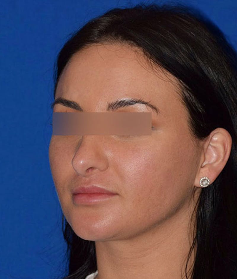 Face Before & After Gallery - Patient 63360789 - Image 4