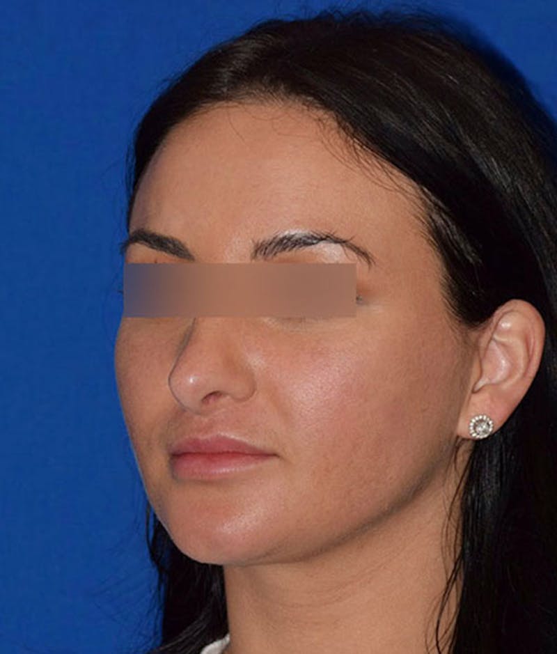 Cosmetic Surgical Before & After Gallery - Patient 63360789 - Image 4