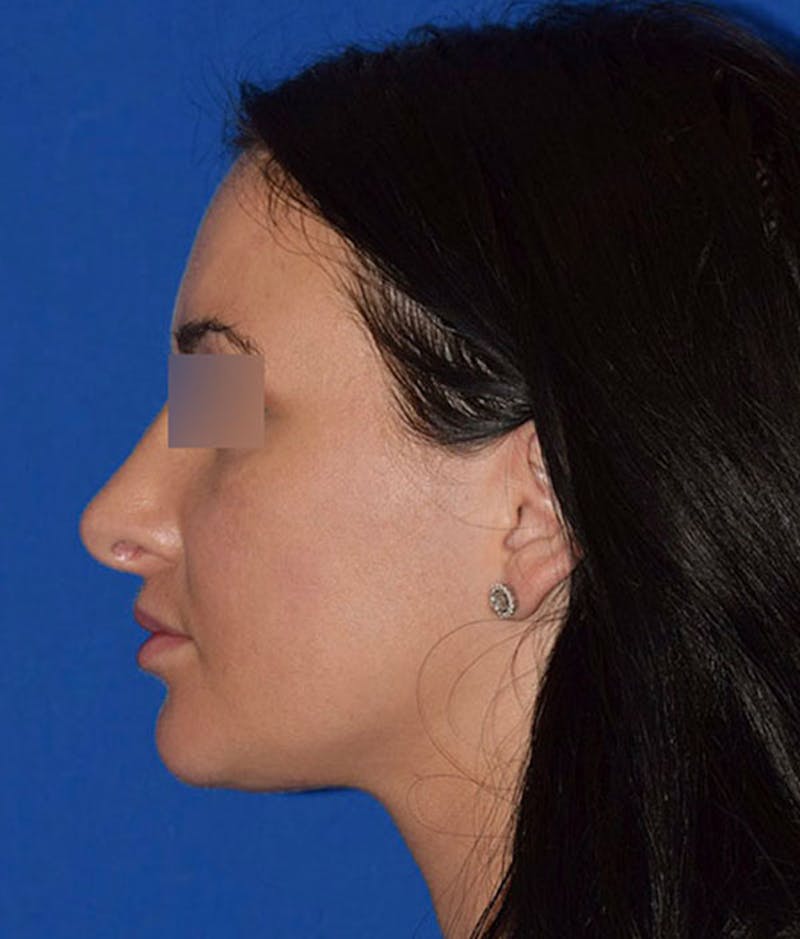 Face Before & After Gallery - Patient 63360789 - Image 6