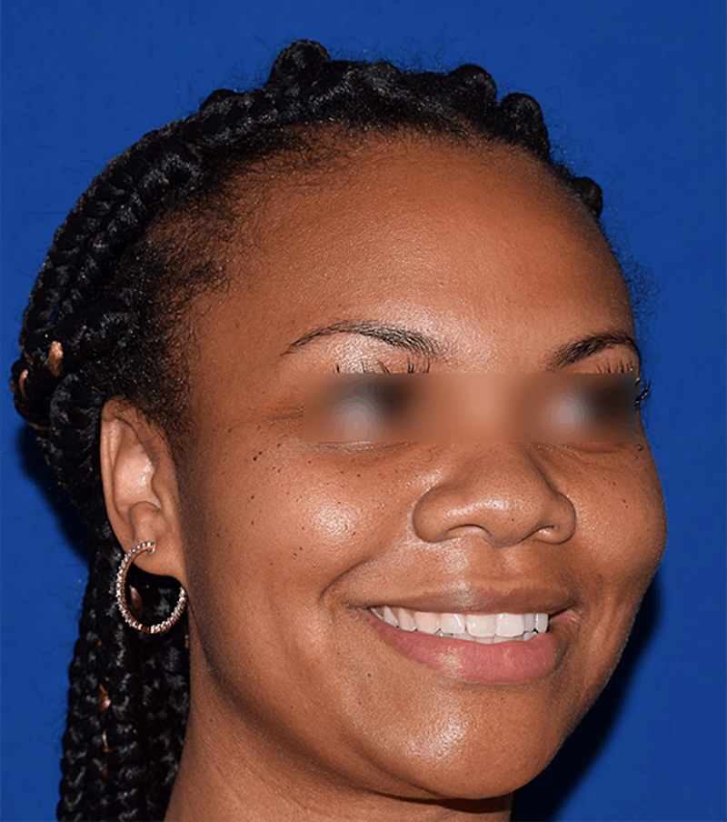 Face Before & After Gallery - Patient 63360817 - Image 3