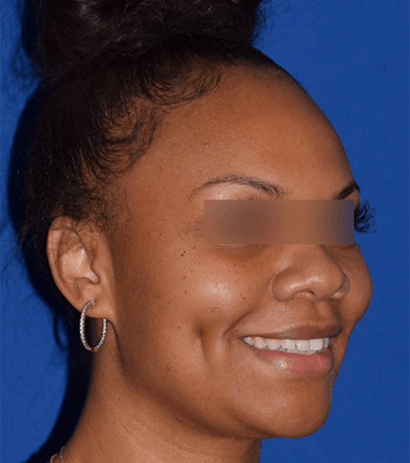 Cosmetic Surgical Before & After Gallery - Patient 63360817 - Image 4