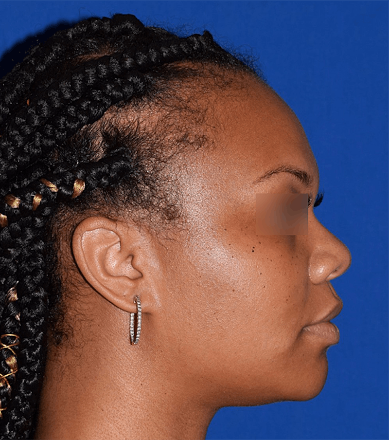 Face Before & After Gallery - Patient 63360817 - Image 5