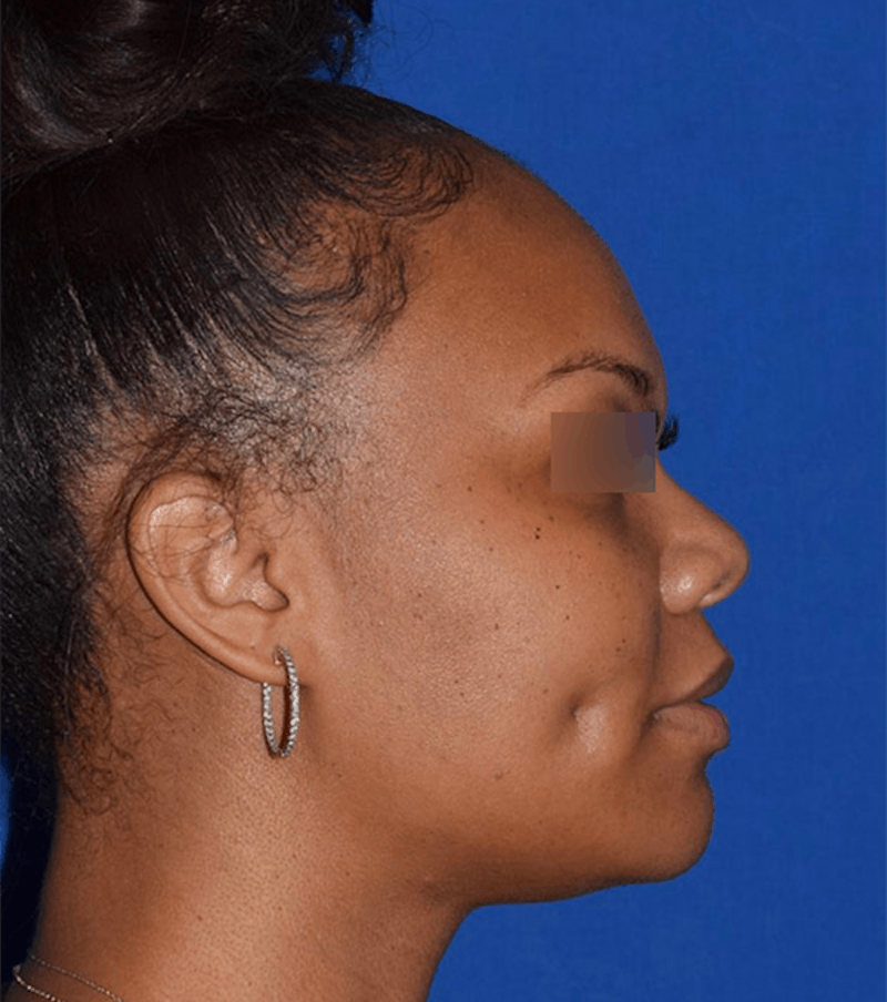 Face Before & After Gallery - Patient 63360817 - Image 6