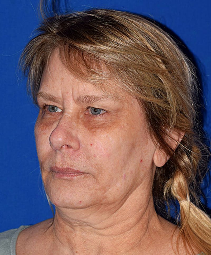 Face Before & After Gallery - Patient 63360820 - Image 3
