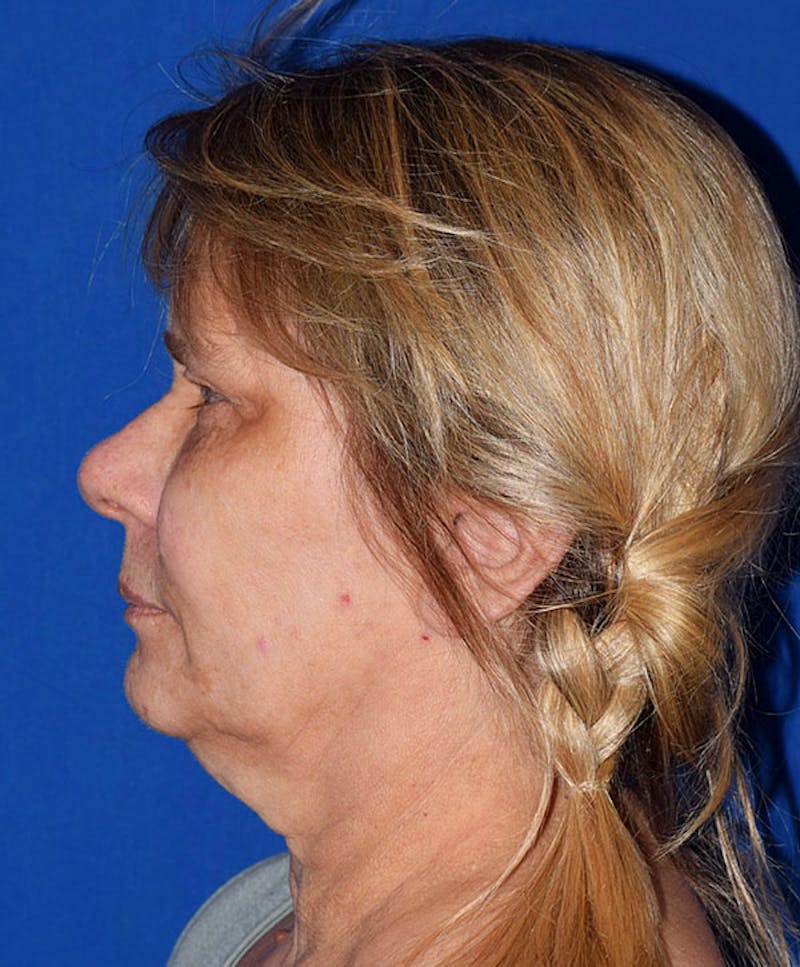 Face Before & After Gallery - Patient 63360820 - Image 5