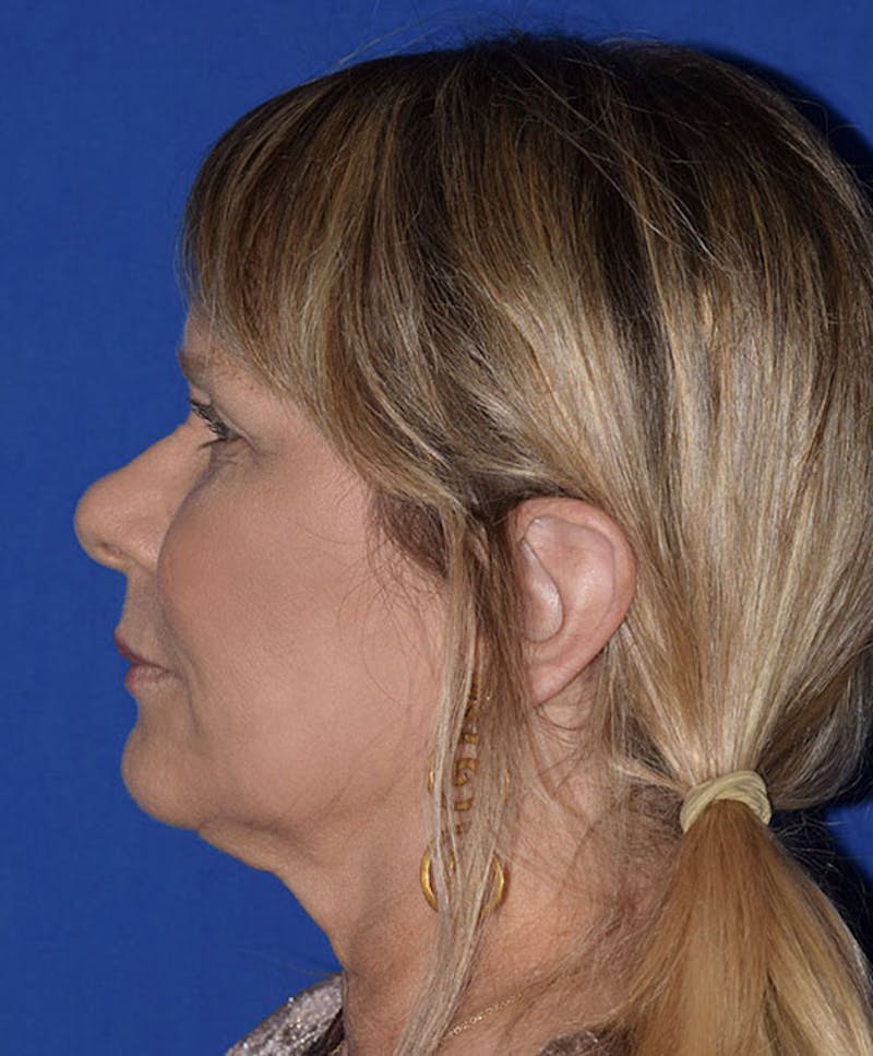 Face Before & After Gallery - Patient 63360820 - Image 6