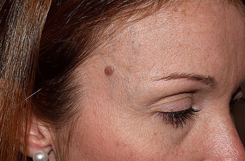 Face Before & After Gallery - Patient 63360821 - Image 1