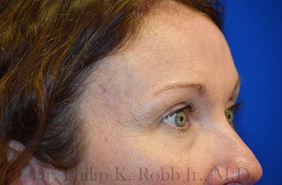 Face Before & After Gallery - Patient 63360821 - Image 2