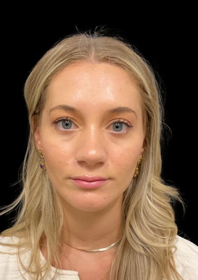 Cosmetic Surgical Before & After Gallery - Patient 63360822 - Image 2
