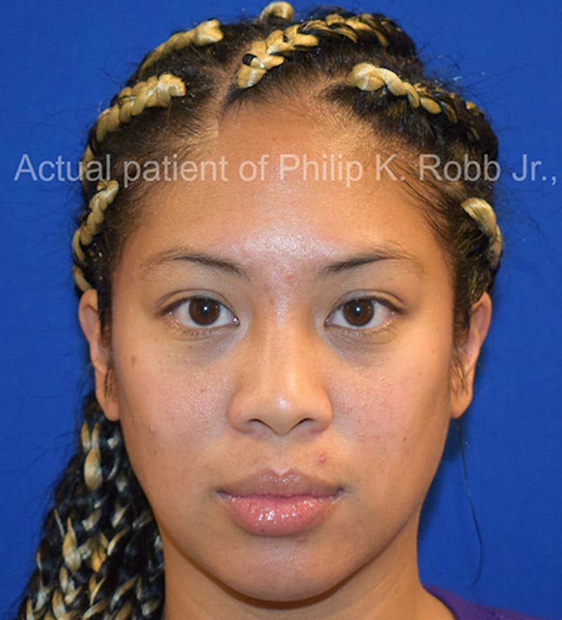 Cosmetic Surgical Before & After Gallery - Patient 63360830 - Image 1