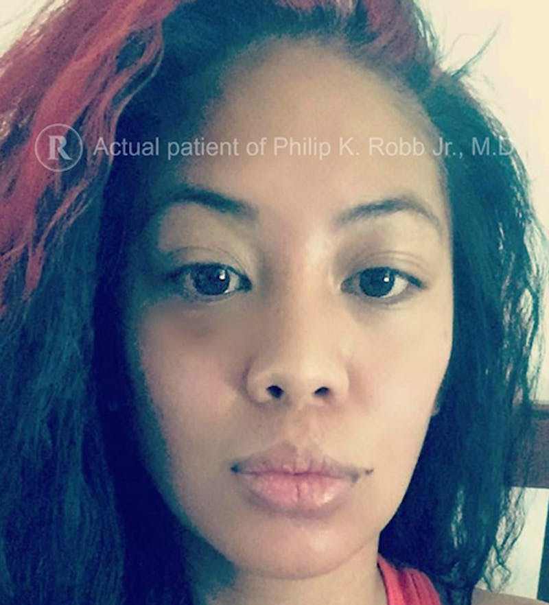 Face Before & After Gallery - Patient 63360830 - Image 2