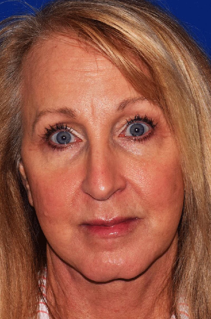 Face Before & After Gallery - Patient 63360836 - Image 2