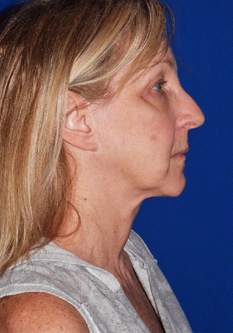 Face Before & After Gallery - Patient 63360836 - Image 3