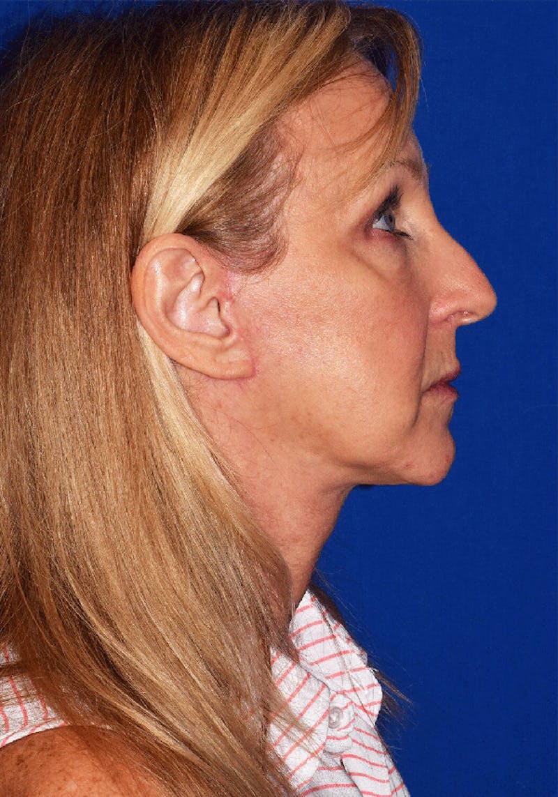 Cosmetic Surgical Before & After Gallery - Patient 63360836 - Image 4