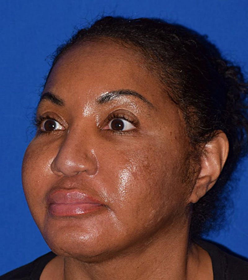 Face Before & After Gallery - Patient 63360839 - Image 3