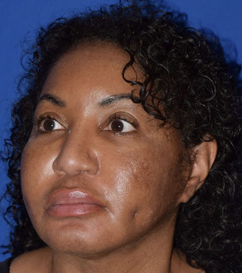 Face Before & After Gallery - Patient 63360839 - Image 4