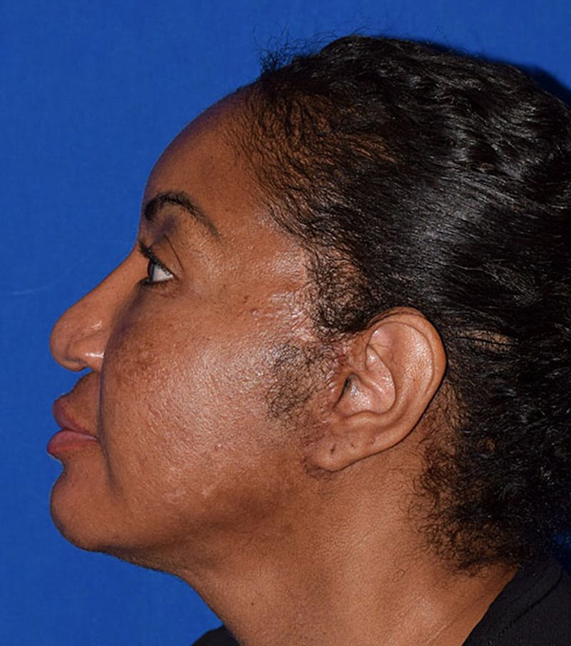 Face Before & After Gallery - Patient 63360839 - Image 5