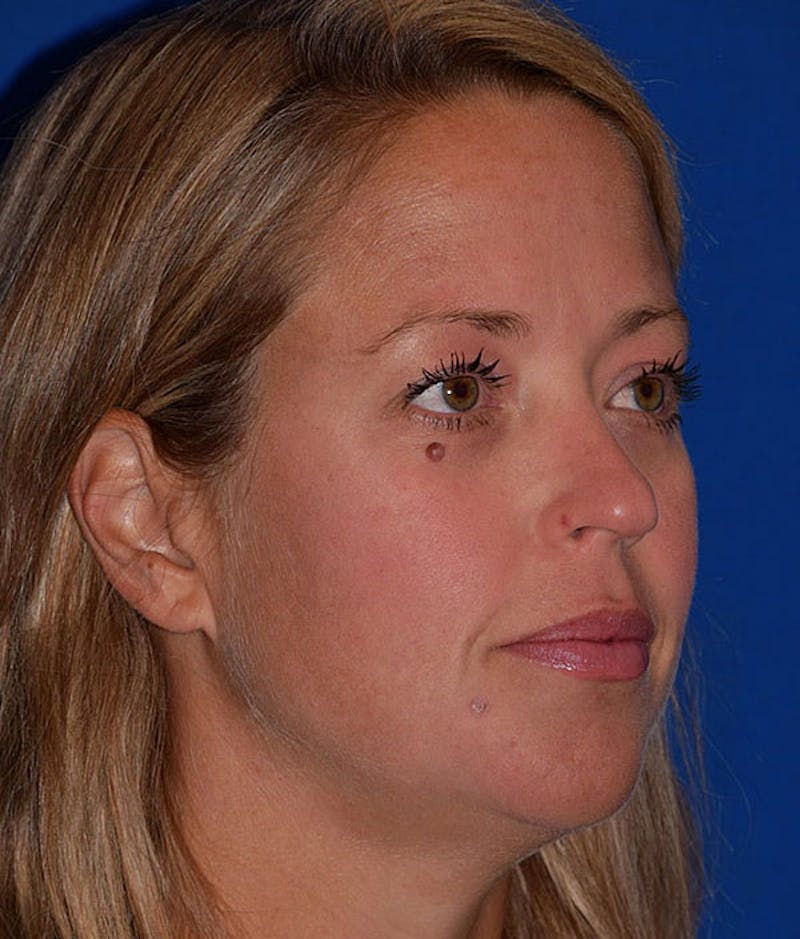 Face Before & After Gallery - Patient 63360842 - Image 3