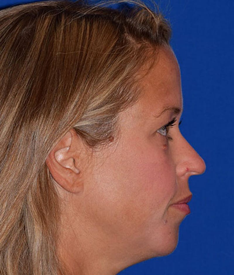 Face Before & After Gallery - Patient 63360842 - Image 5