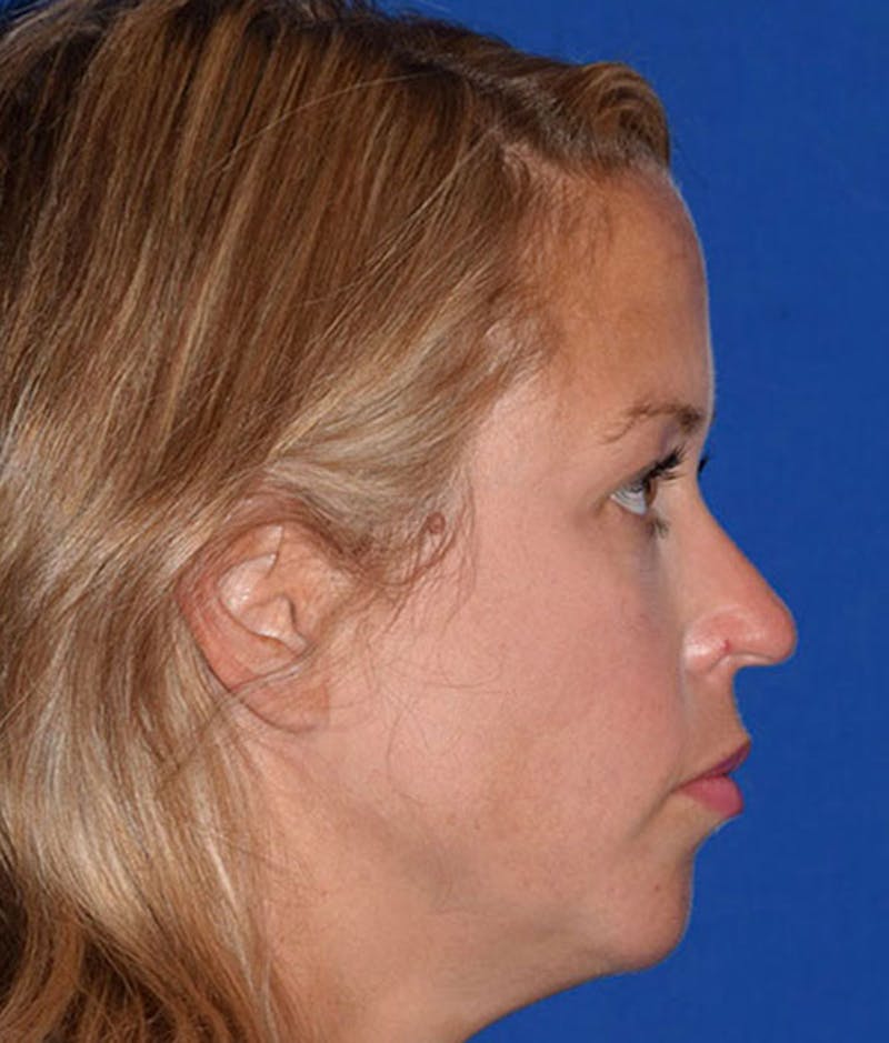 Face Before & After Gallery - Patient 63360842 - Image 6