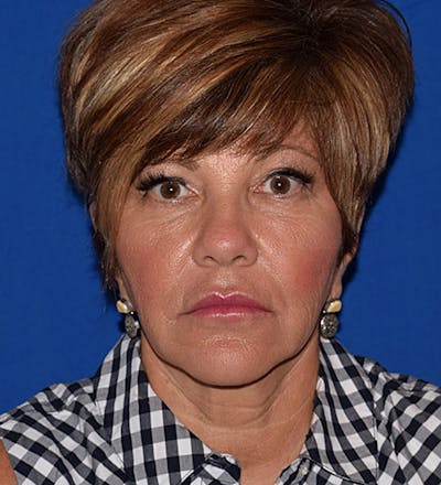 Face Before & After Gallery - Patient 63360845 - Image 1