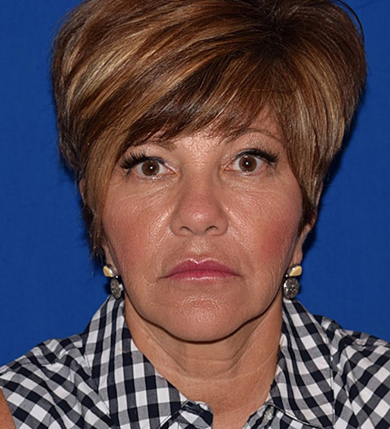 Face Before & After Gallery - Patient 63360845 - Image 1