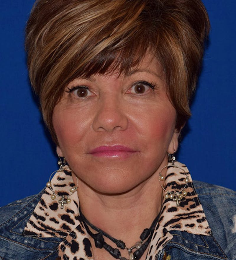 Face Before & After Gallery - Patient 63360845 - Image 2