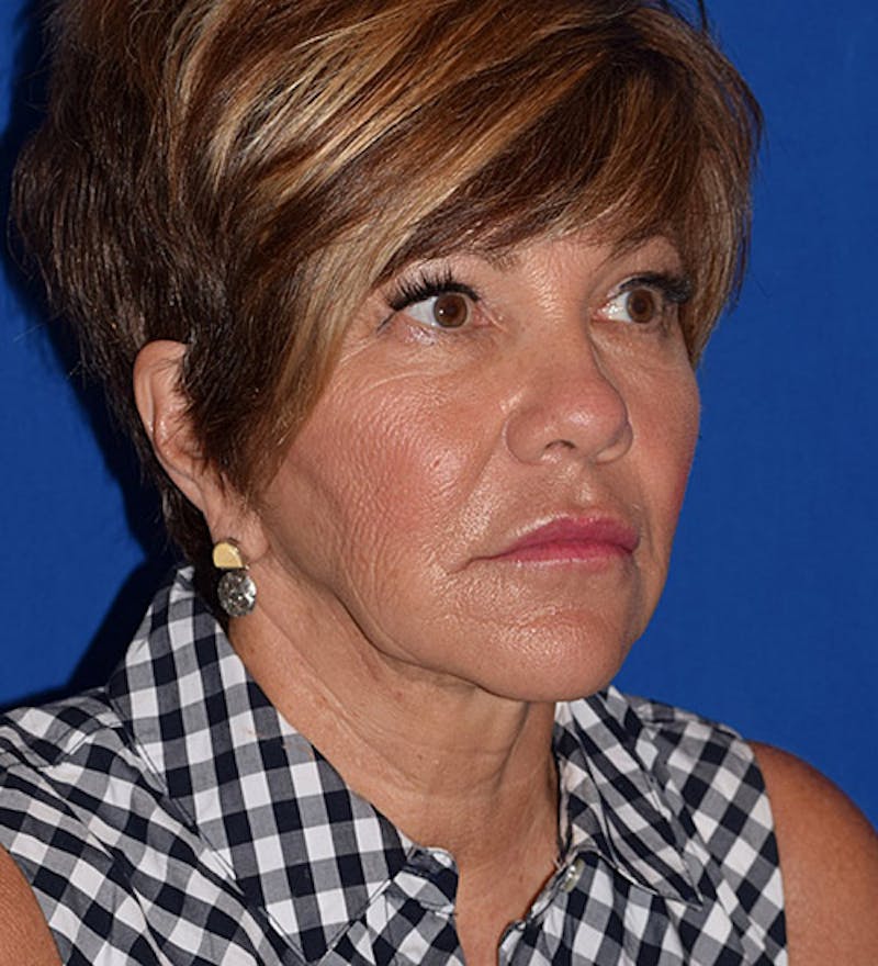 Face Before & After Gallery - Patient 63360845 - Image 3