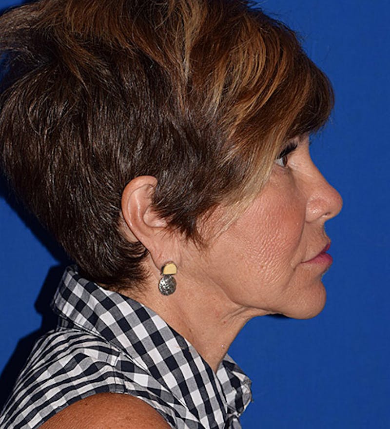 Face Before & After Gallery - Patient 63360845 - Image 5