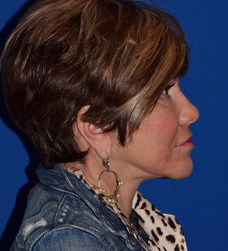 Face Before & After Gallery - Patient 63360845 - Image 6