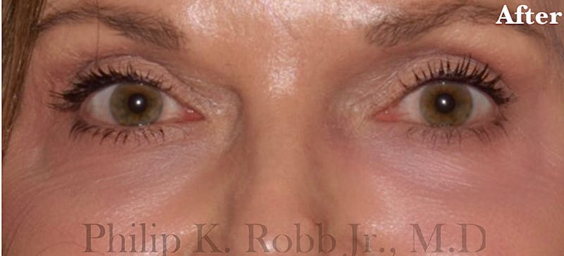 Face Before & After Gallery - Patient 63360847 - Image 2