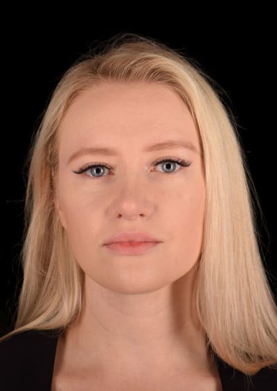 Cosmetic Surgical Before & After Gallery - Patient 63360848 - Image 2