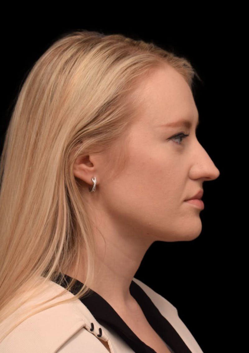 rhinoplasty before and after photos
