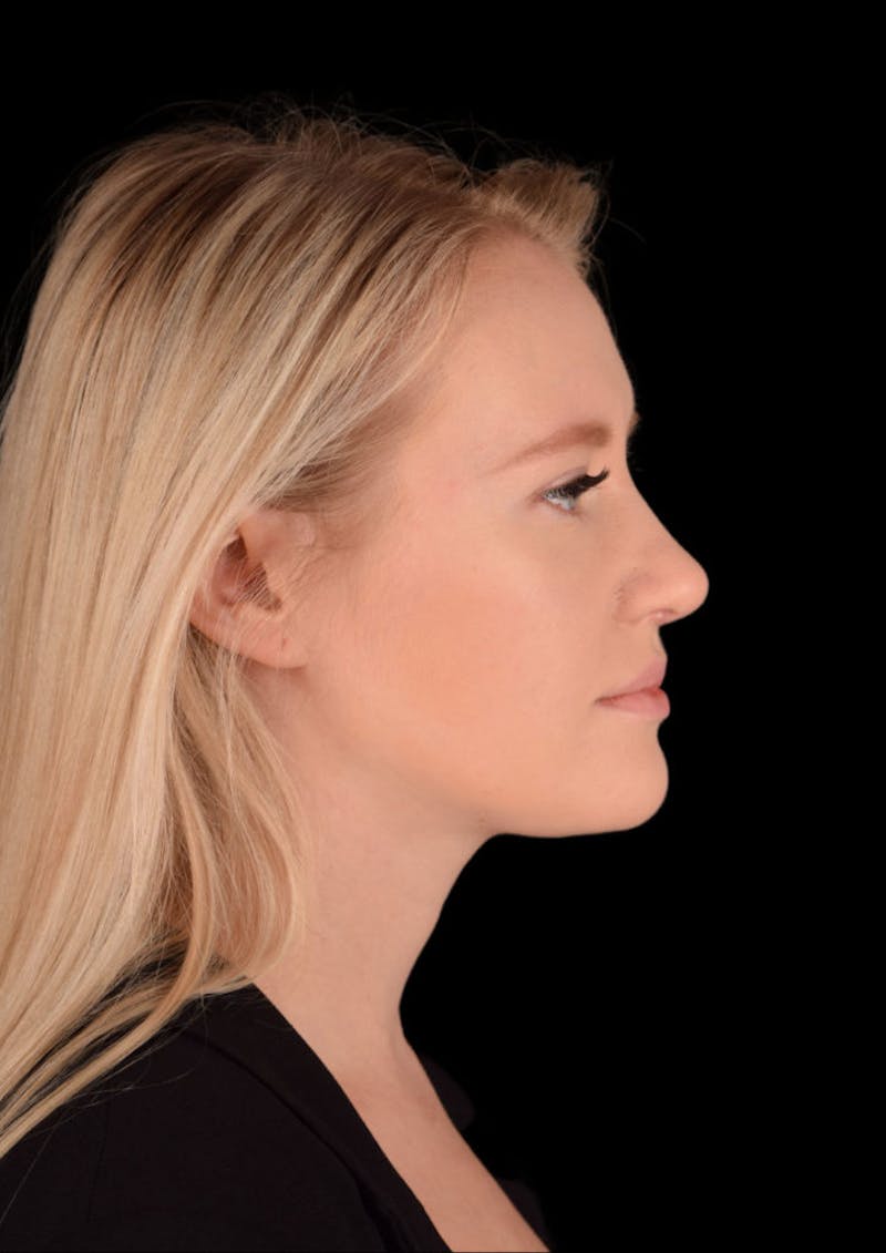 rhinoplasty before and after photos